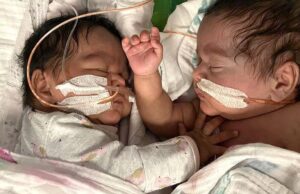 Πρόωρα διδυμάκια έπαθαν μηνιγγίτιδα και σήψη, αλλά νίκησαν τον θάνατο μαζί! Πρόωρα-διδυμάκια-έπαθαν-μηνιγγίτιδα-και-σήψη,-αλλά-νίκησαν-τον-θάνατο-μαζί!