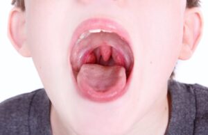 Strept test και στρεπτοκοκκικές λοιμώξεις – Ποια είναι η αλήθεια strept-test-και-στρεπτοκοκκικές-λοιμώξεις-–-Ποια-είναι-η-αλήθεια
