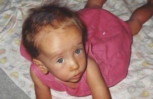 Τι είναι το σύνδρομο Sotos που εμφανίζεται σε 1 στα 10.000 παιδιά; Τι-είναι-το-σύνδρομο-sotos-που-εμφανίζεται-σε-1-στα-10.000-παιδιά;