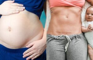 Μητέρα δείχνει την καισαρική τομή της και κλείνει το στόμα σε όσους την έκριναν πώς πήρε «τον εύκολο δρόμο» Μητέρα-δείχνει-την-καισαρική-τομή-της-και-κλείνει-το-στόμα-σε-όσους-την-έκριναν-πώς-πήρε-«τον-εύκολο-δρόμο»