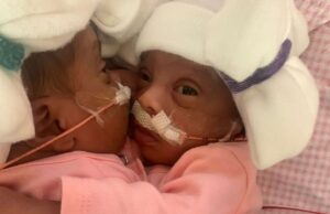 Σιαμαία που γεννήθηκαν με ενωμένη κοιλιά, διαχωρίστηκαν μετά από επέμβαση 24 ωρών! Σιαμαία-που-γεννήθηκαν-με-ενωμένη-κοιλιά,-διαχωρίστηκαν-μετά-από-επέμβαση-24-ωρών!