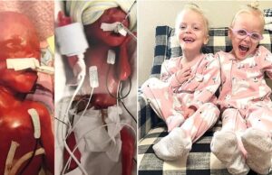 Τα πιο πρόωρα δίδυμα του κόσμου είναι πλέον 3 χρονών και μας γεμίζουν ελπίδα! Τα-πιο-πρόωρα-δίδυμα-του-κόσμου-είναι-πλέον-3-χρονών-και-μας-γεμίζουν-ελπίδα!