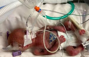 Μωράκι που γεννήθηκε στις 20 εβδομάδες δίνει μάχη για τη ζωή του! Μωράκι-που-γεννήθηκε-στις-20-εβδομάδες-δίνει-μάχη-για-τη-ζωή-του!