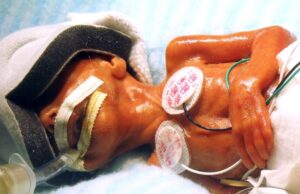 Γεννήθηκε μόλις μισό κιλό, επιβίωσε και σήμερα παίζει μουσική στα πρόωρα Γεννήθηκε-μόλις-μισό-κιλό,-επιβίωσε-και-σήμερα-παίζει-μουσική-στα-πρόωρα