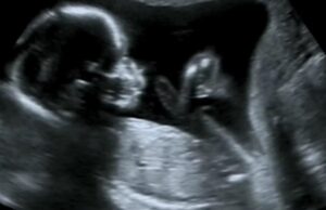 Πρωτοποριακή επέμβαση έσωσε έμβρυο: το εγχείρησαν στον εγκέφαλο μέσα από την κοιλιά της μαμάς του Πρωτοποριακή-επέμβαση-έσωσε-έμβρυο:-το-εγχείρησαν-στον-εγκέφαλο-μέσα-από-την-κοιλιά-της-μαμάς-του