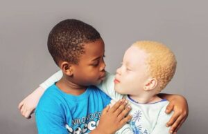 Πώς μια μητέρα γέννησε «ασπρόμαυρα» δίδυμα