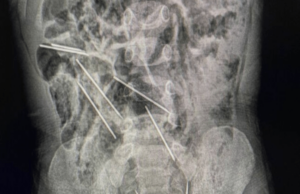 Περού: Αγόρι κατάπιε οκτώ μεγάλες βελόνες από ενέσεις για ζώα