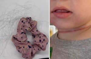 Μωρό παραλίγο να πεθάνει από ασφυξία – το… στραγγάλισαν τα μαλλιά της μαμάς του!