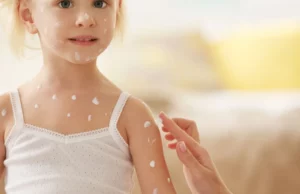 Κρέμες κορτιζόνης – Πότε να τις χρησιμοποιούν οι γονείς και γιατί δεν πρέπει να κάνουν κατάχρηση