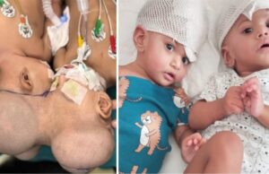 Διδυμάκια ενωμένα στο κεφάλι διαχωρίστηκαν μετά από δύσκολη επέμβαση 14 ωρών