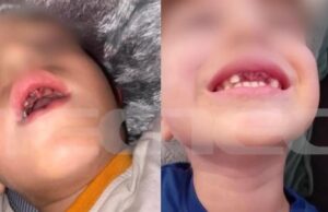 5χρονοι γρονθοκόπησαν 4χρονο συμμαθητή τους με αυτισμό – του έσπασαν 4 δόντια