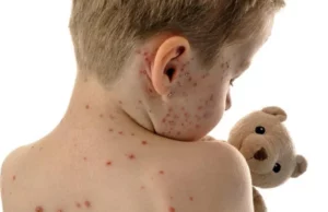 Στο νοσοκομείο 12μηνο βρέφος με Ιλαρά – Η κατάσταση της υγείας του