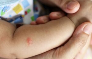 Κάτι τσίμπησε το παιδί: Τι κάνουμε τώρα;