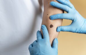 Σπίλοι (ελιές) VS παιδιά: Πότε πρέπει ν’ ανησυχήσουμε;