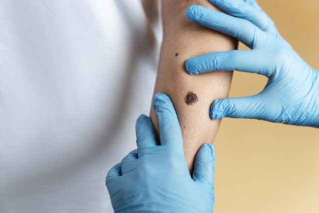 moles