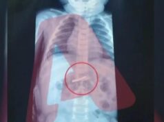 Αγωνιά για 3χρονο που κατάπιε ξυραφάκι – νοσηλεύεται στο Παίδων