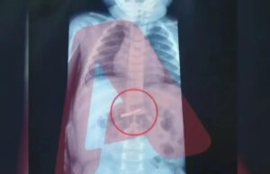 Αγωνιά για 3χρονο που κατάπιε ξυραφάκι – νοσηλεύεται στο Παίδων